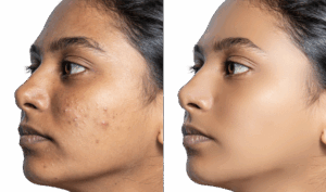 Natural Acne Treatment for Clear and Healthy Skin – Vydyans Clinic Young woman receiving natural acne treatment at Vydyans Ayurveda Skin Clinic in Vylathur