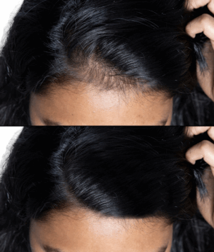 Hair Loss Treatment and Herbal Scalp Care at Vydyans Clinic Natural scalp and hair loss treatment session at Vydyans Ayurveda Clinic in Vylathur, kerala